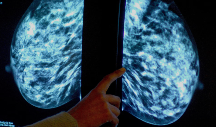 The NHS will start the world’s largest trial for using AI to diagnose breast cancer